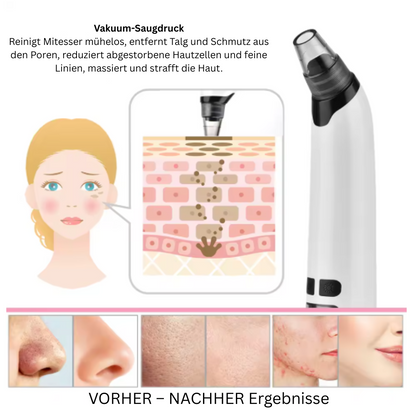 ClearSkin Pro – Elektrischer Mitesser-Entferner mit Wärmefunktion MySalvora